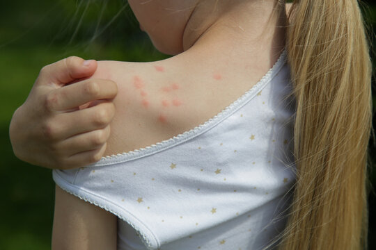 Red, swollen and itchy spots on skin caused by insect bites or allergy. Skin reaction to insect bites. 