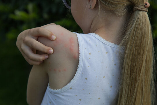 Red, swollen and itchy spots on skin caused by insect bites or allergy. Skin reaction to insect bites. 