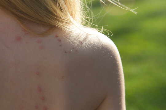 Red, swollen and itchy spots on skin caused by insect bites or allergy. Skin reaction to insect bites. 
