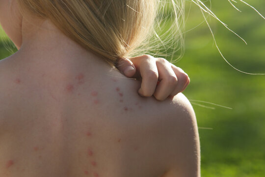 Red, swollen and itchy spots on skin caused by insect bites or allergy. Skin reaction to insect bites. 