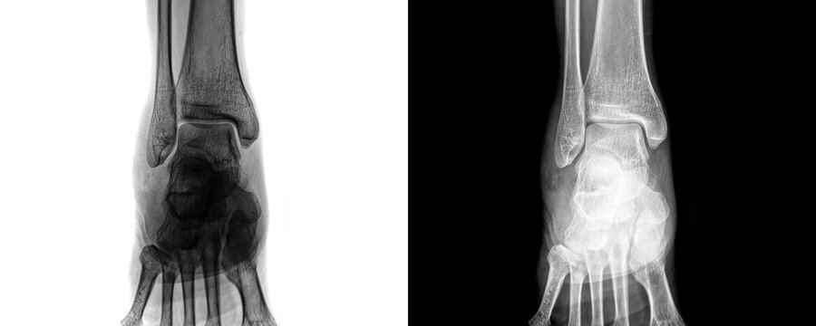 Diagnostic Radiograph of Ankle Joint in Anterior View Showing Articular Surfaces and Bone Alignment for Fracture Assessment Isolated on Transparent Background