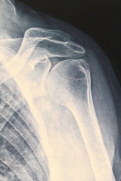 Anteroposterior X-ray projection of a human shoulder joint showing the humeral head glenoid cavity acromion process and clavicle for medical diagnostic and radiological examination of skeletal system