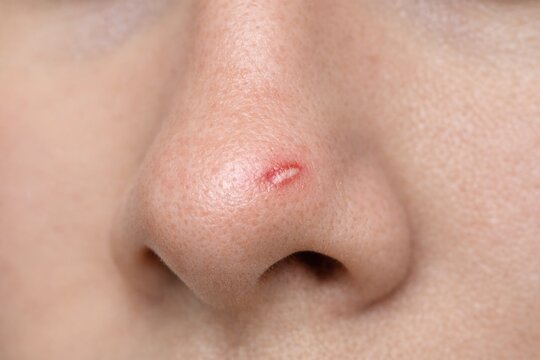 Close-up shot of a person's face with a small red spot on the tip of their nose
