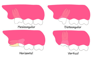 vector illustration set of impacted upper molar wisdom teeth © Ika