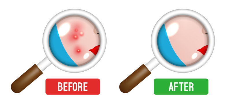 Acne skin. Before and after. Skin under a magnifying glass. Vector illustration.