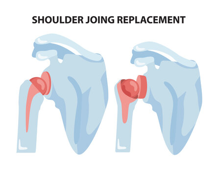Shoulder joint replacement diagram. Vector illustration