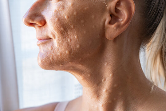 Woman's face after mesotherapy injections biorevitalization. beauty injections. High quality photo