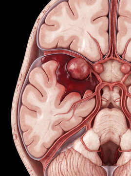 Human brain cross-section with ruptured aneurysm causing severe hemorrhage, detailed brain anatomy, and intricate blood vessels on a black background