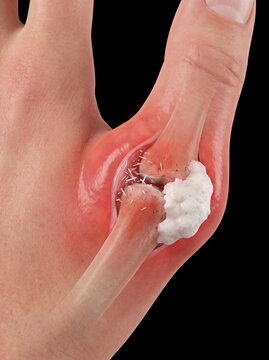 Anatomy of human thumb joint with inflammation and uric acid crystal deposits, illustrating gout or arthritis on a black background.