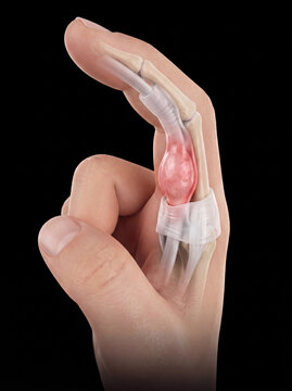 Human finger with visible anatomical structure showing a swollen, inflamed flexor tendon, representing trigger finger or tenosynovitis on a black background.