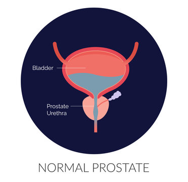 Normal Prostate Gland under Bladder - Stock Illustration
