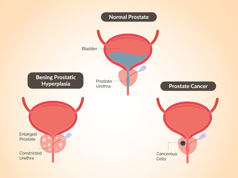 Normal Prostate - Enlarged Prostate Gland and Prostate cancer - Stock Illustration
