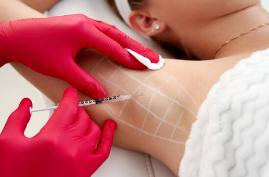 Doctor makes injections of botulinum toxin in the underarm area against hyperhidrosis in beauty salon. Female cosmetology and problems with sweating concept