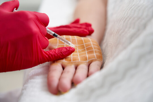 cosmetologist makes injections of botulinum toxin on the palms of a woman against hyperhidrosis. Female cosmetology, skin