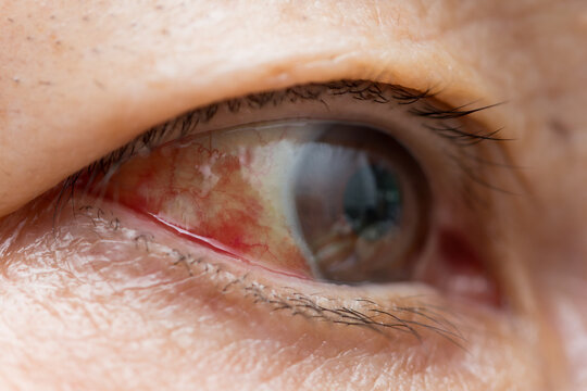 Close-up of subconjunctival hemorrhage, broken capillary in the eye causing red patch on the sclera, ophthalmology and healthcare concept