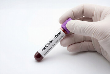 Fototapeta premium Gloved hand holding blood sample tube for von willebrand factor test