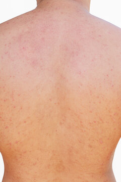 Texture red rash on back man