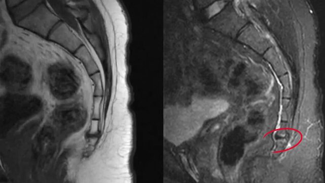 Saggital view coccyx magnetic resonance imaging showing tailbone pain. Detailed radiological scan highlighting coccygeal joint dysfunction and site for therapeutic injection in spinal medicine