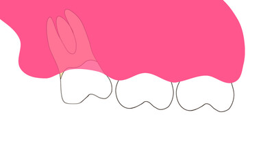 Mesioangular upper wisdom teeth impaction illustration © Ika