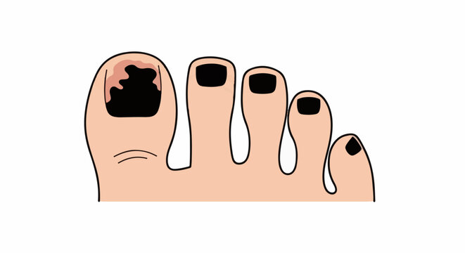 Toes with one discolored and damaged nail