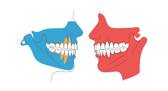 Comparison of human jaw alignment showing bite issues like overbite or underbite for orthodontic treatment planning.
