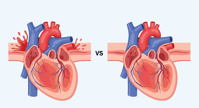 Heart comparison showing a septal defect versus a healthy heart illustrates congenital cardiac conditions for medical education.