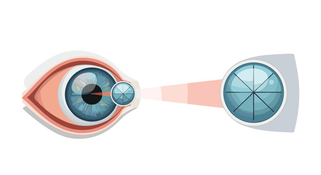 Detailed diagram of a human eye being measured or treated with a specialized lens or tool to illustrate ophthalmic procedures and vision care.