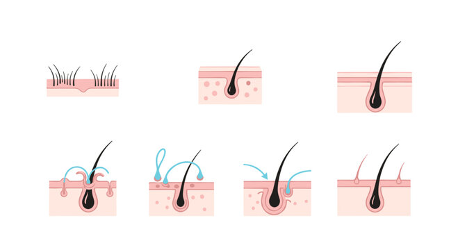 Set of anatomical illustrations showing different stages of hair growth and common follicle conditions under the skin.