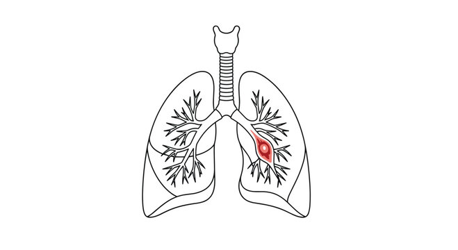Simple outline drawing of the human respiratory system highlighting a red tumor or lesion within the right lung lobe.