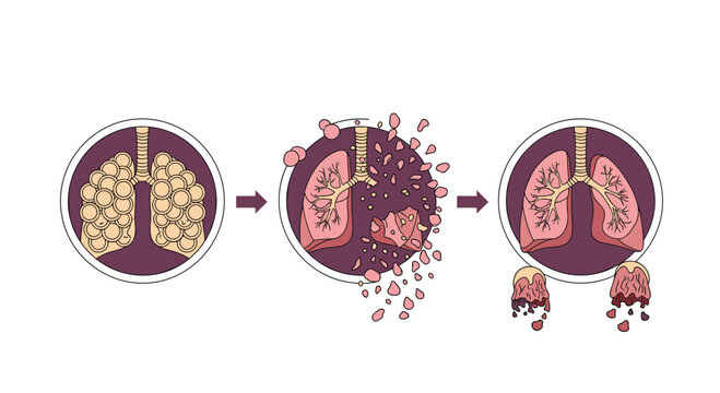 Three stage medical diagram illustrating the progression of lung tissue damage or the effects of a specific respiratory disease.