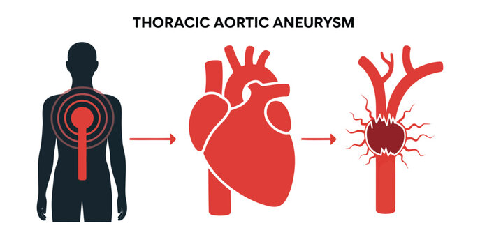 Thoracic aortic aneurysm illustration progression and anatomical representation