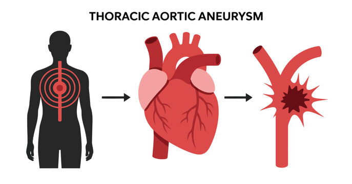 Thoracic aortic aneurysm illustration progression and rupture