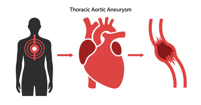 Thoracic aortic aneurysm medical illustration
