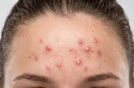 Close up of human forehead skin with single inflamed acne pimple, dermatology concept, problem skin