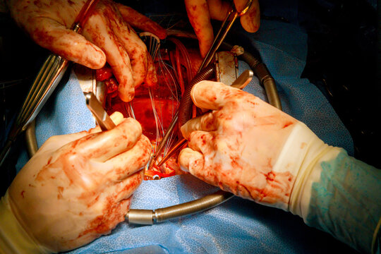 Surgeons perform operation on patient in hospital during major heart surgery