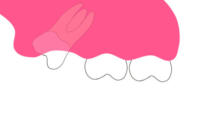 Distoangular maxillary wisdom teeth impaction buccal view © Ika