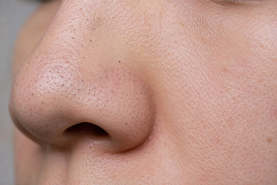 Close Up of Blackheads and Enlarged Pores on Nose Skin