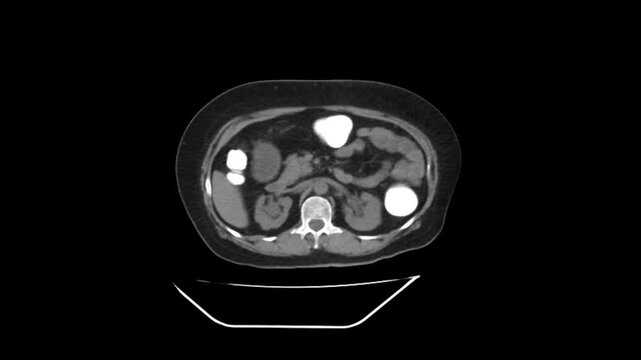 Pelvic and Abdominal Computed Tomography Video for Internal Tumors and Pathology Screen