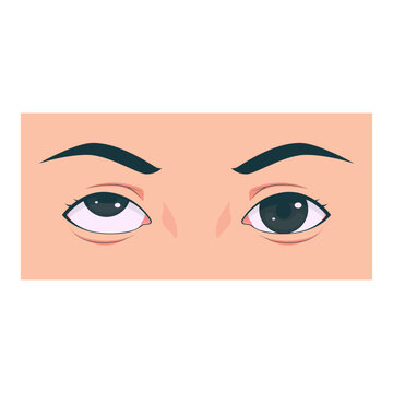 Medical illustration showing different types of strabismus eye disorders including esotropia, exotropia, hypertropia, and normal eye comparison. Suitable for healthcare education, ophthalmology presen