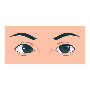 Medical illustration showing different types of strabismus eye disorders including esotropia, exotropia, hypertropia, and normal eye comparison. Suitable for healthcare education, ophthalmology presen