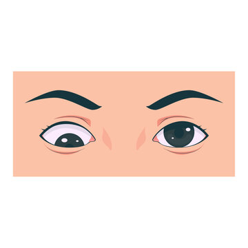 Medical illustration showing different types of strabismus eye disorders including esotropia, exotropia, hypertropia, and normal eye comparison. Suitable for healthcare education, ophthalmology presen