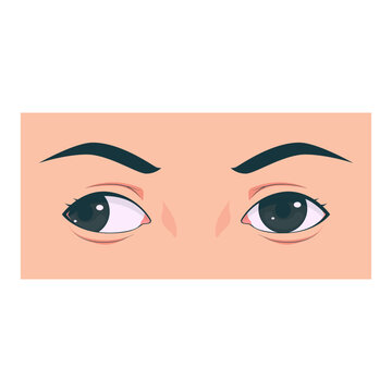 Medical illustration showing different types of strabismus eye disorders including esotropia, exotropia, hypertropia, and normal eye comparison. Suitable for healthcare education, ophthalmology presen