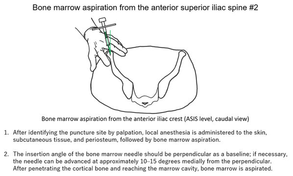 bone marrow aspiration from the anterior superior iliac spine #2