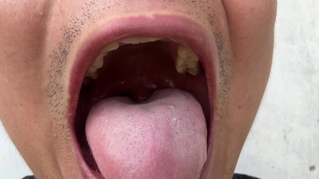 Close up of a man opening his mouth to show dental problems