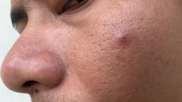 Close Up of Man Face with Acne and Large Pores