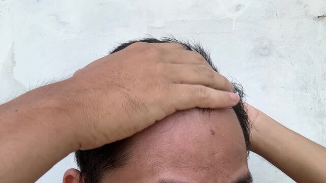 Man examining receding hairline and thinning hair with comb