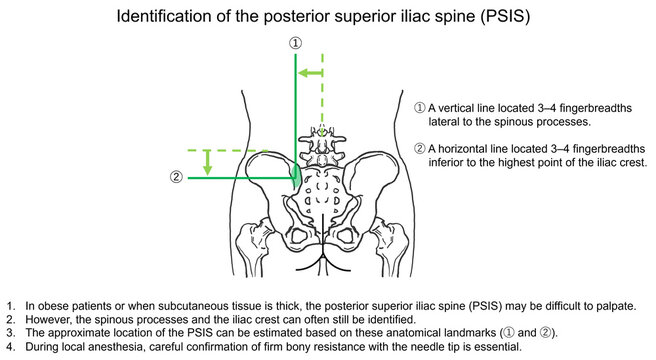 Identification of the posterior superior iliac spine (PSIS)