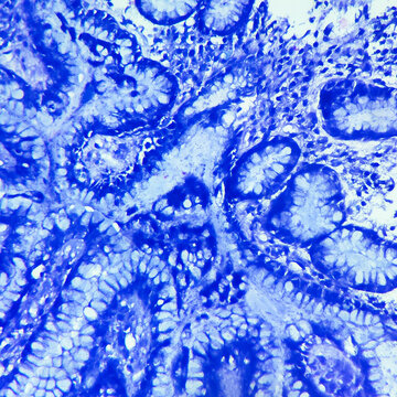Camera photo of H.pylori associated gastritis, showing curved organisms along foveolar surface in Giemsa stain, magnification 400x, photograph through a microscope