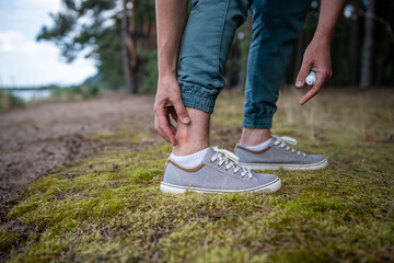 Man with mosquitoes bites, itching leg, applying balm or cream on swell skin, suffering from allergic reaction. Individual intolerance to insect bites. Male attacked by gnats in forest at summer