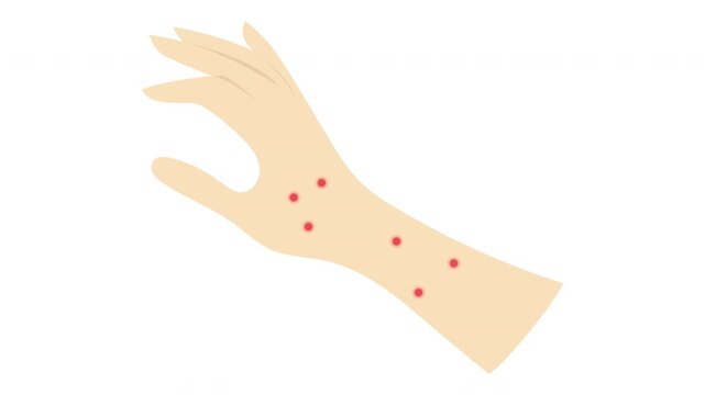 Closeup Arm With Multiple Mosquito Bites And Red Itchy Skin Irritation On Forearm